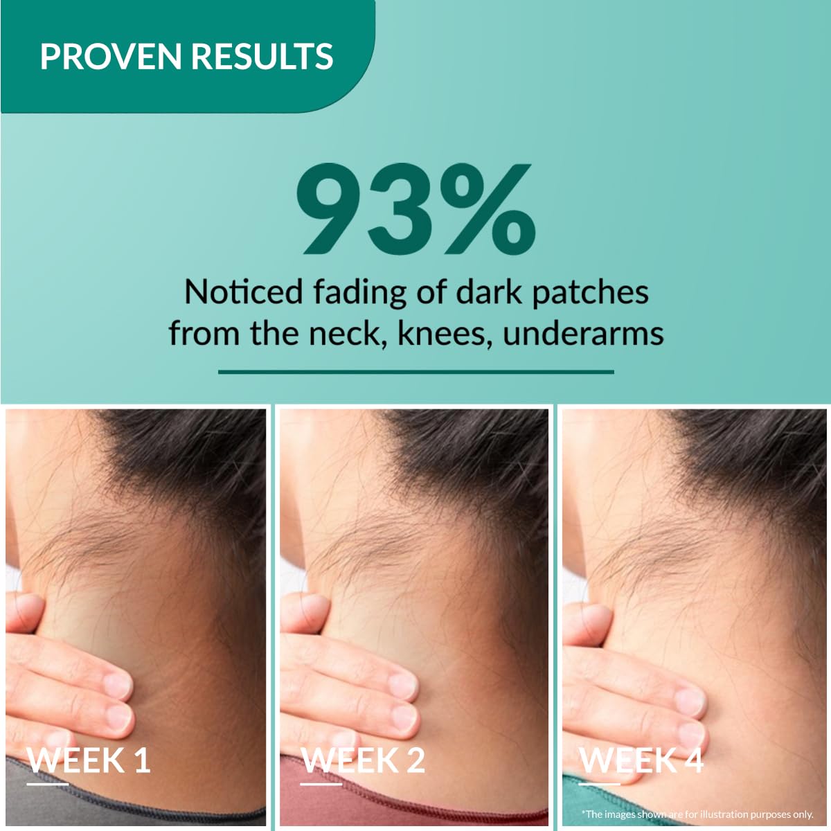 FIXDERMA NIGRIFIX CREAM FOR ACANTHOSIS NIGRICANS WITH LACTIC ACID DERMATOLOGIST TESTED 50GM